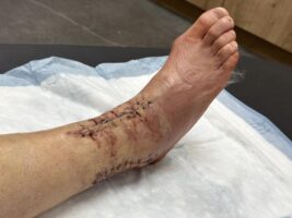 Staples about to be Removed