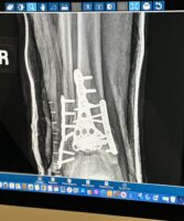 First Xray Post Surgery - February 2024